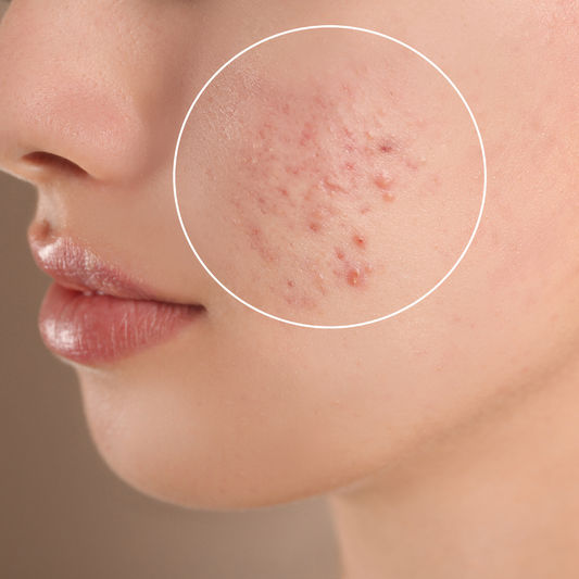 El Tratamiento  Natural Más Efectivo Contra El Acné | Qué es y cómo eliminarlo definitivamente - Sualan Cosmetics