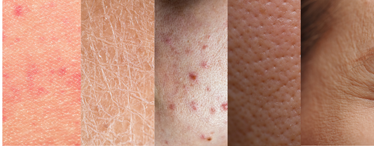 ¿Cómo detectar tu tipo de piel? - Sualan Cosmetics